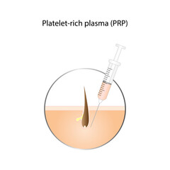 Platelet-rich plasma (prp), a concentrate of platelet-rich plasma extracted from whole blood.  PRP treatment for rejuvenation and recovery of skin and hair. Syringe, hair follicle. Vector design.