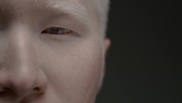 Close up portrait of the eye of an Asian albino guy. Genetic mutation of the pigment. Man with nystagmus, uncontrolled rhythmic movements of the eyeballs, Pathological eyes, white hair and eyebrows