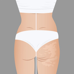 Deep cellulite reduction Body contouring Lifting with . Physiotherapy, lymphatic drainage