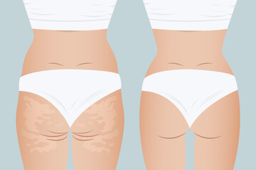 Rear view of a girl, illustration before and after weight loss. Female figure with and without cellulite. Fat deposits on women's thighs. Problem areas of the female buttocks.
