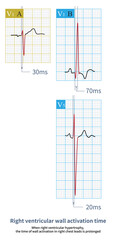 When right ventricular hypertrophy, the time of wall activation in right chest leads is prolonged.Figure A shows the normal control, and Figure B shows right ventricle hypertrophy.