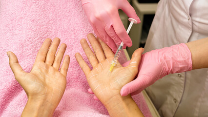 Fototapeta premium Treatment hyperhidrosis botulinum toxin