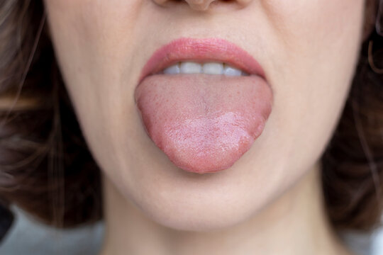 Close-up swelling of the tongue. Allergic reactions, Infections, Angioedema, Trauma or injury, Oral surgery or dental procedures