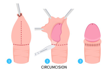 Herpes simplex virus and Circumcision paraphimosis for phimosis swelling pain with HSV and HPV Redness itchy prepuce Genital candidiasis yeast bacteria preputial adhesion Medical anatomy