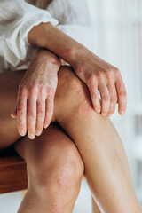 Psoriasis. Acute psoriasis on the knees, body, elbows is an autoimmune, incurable dermatological...