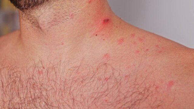 Man with acne, red spots, skin disease. Varicella or Herpes Zoster concept