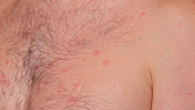 Man with acne, red spots, skin disease. Varicella or Herpes Zoster concept
