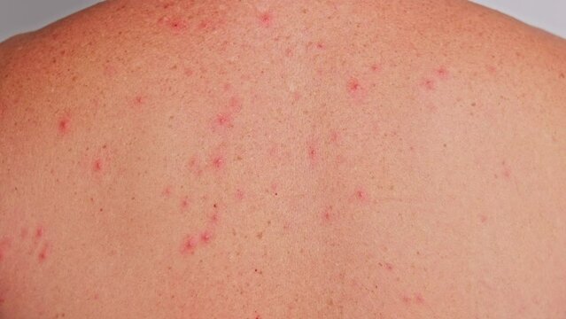 Man's back with acne, red spots, skin disease. Varicella or Herpes Zoster concept