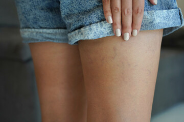 Young woman with varicose and spider veins on her leg. Close-up of skin problem on woman leg.