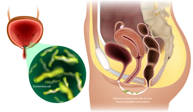 Urinary Tract Infections in Women. Bacteria coming from the rectum found in bladder and urethra. Escherichia coli. Abacterial cystitis 