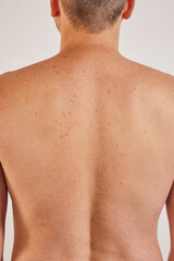 Naklejka premium Man's back with acne, red spots, skin disease