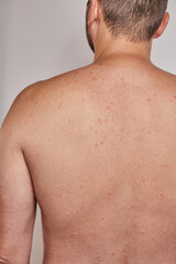 Man's back with acne, red spots, skin disease