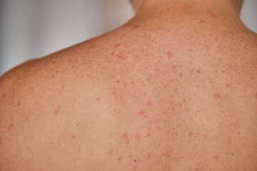 Man's back with acne, red spots, skin disease