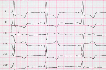ECG. Myocardial infarction on ECG, subendocardial ischemia in standard and enhanced leads. Angina....
