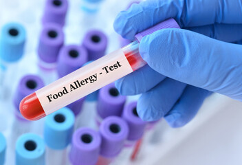 Doctor holding a test blood sample tube with food allergy test on the background of medical test...
