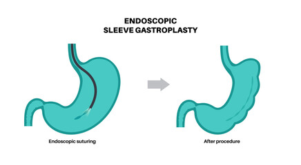 Obraz na płótnie Canvas Endoscopic sleeve gastroplasty