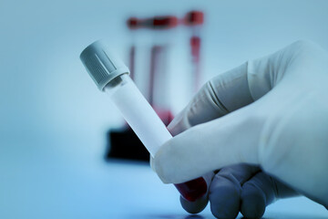 Hand of a doctor holding a bottle of blood sample.