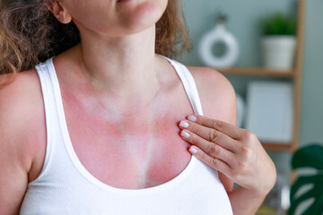 Woman with sunburn on skin with traces of swimsuit