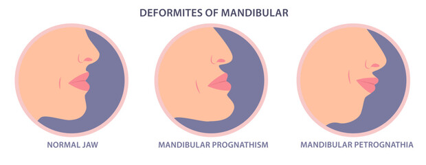 Deformities of mandibular vector illustration. Mandibular deficiency and excess. Jaw surgery and modification. Facial deficiency, midfacial problems. Jaw Deformity. maxillary prognathism correction.