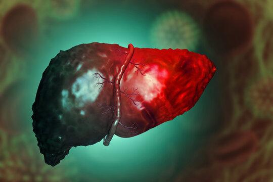 Liver damage such as Fatty liver, Fibrosis, Cirrhosis, and Liver cancer. 3d illustration