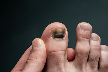 toe with nail damage and bruise