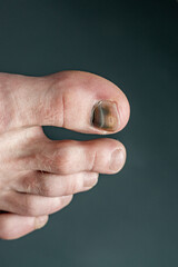 finger with nail damage and bruise