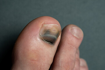 finger with nail damage and bruise