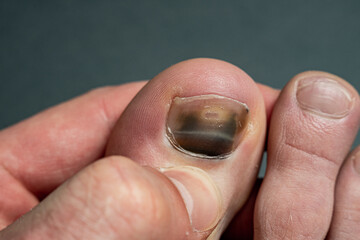 finger with nail damage and bruise