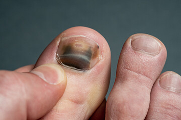 finger with nail damage and bruise