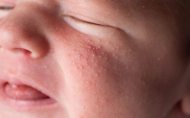 Fototapeta premium Allergic pimples in a newborn on the face. Pathogenesis, acne of newborns.