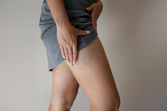 Painful varicose veins on woman legs