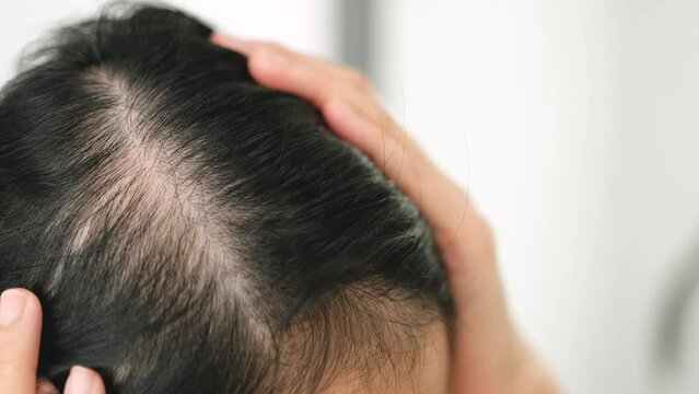 Asian woman parting her hair revealing hair loss or thinning hair.