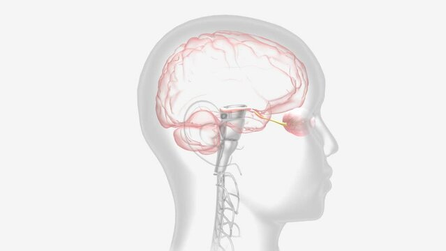 Optic neuritis occurs when swelling (inflammation) damages the optic nerve