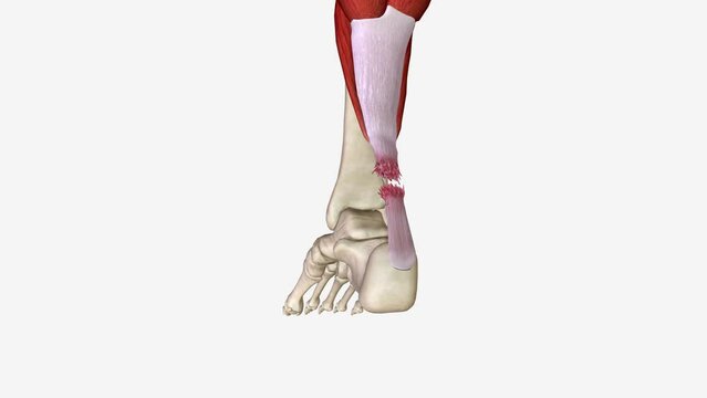 Flexion and Extension with Torn Achilles Tendon