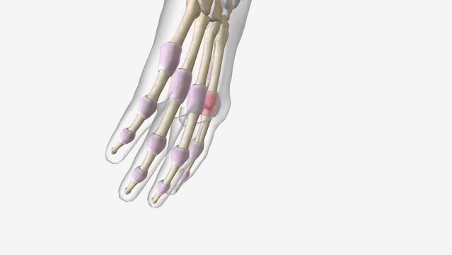 Early Arthritis in Metacarpophalangeal Joint