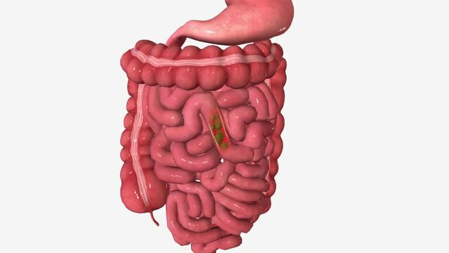 Diarrhea is when your stools are loose and watery. You may also need to go to the bathroom more often