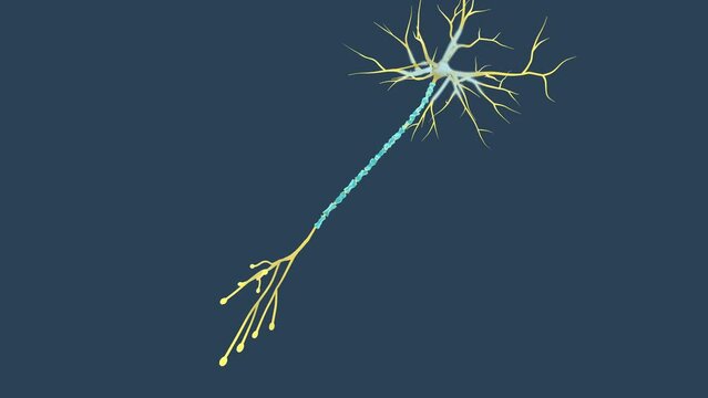 Neuron with Degenerated Myelin Sheath