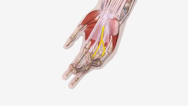 Dupuytren is Contracture Multi cord