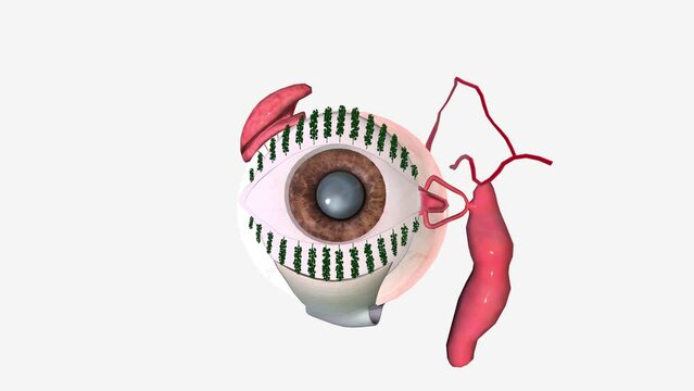 A cataract is a cloudy area in the lens of your eye (the clear part of the eye that helps to focus light)