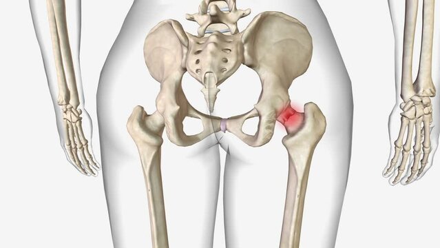 Femoral neck fractures are a specific type of intracapsular hip fracture