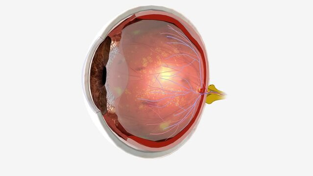 Diabetic retinopathy is an eye condition that can cause vision loss and blindness in people who have diabetes