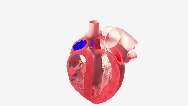 Atrial Septal Defect Blood Flow