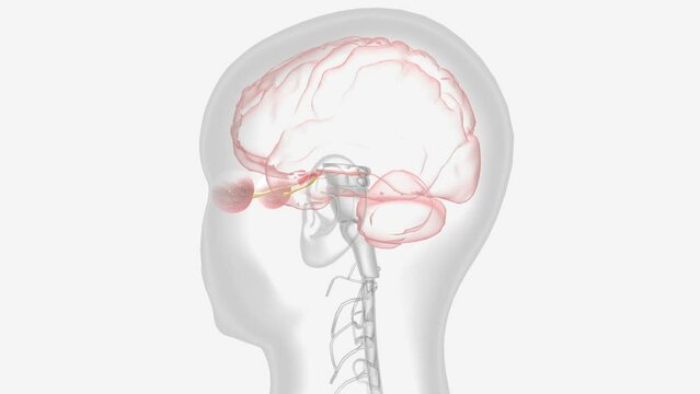 Optic neuritis occurs when swelling (inflammation) damages the optic nerve
