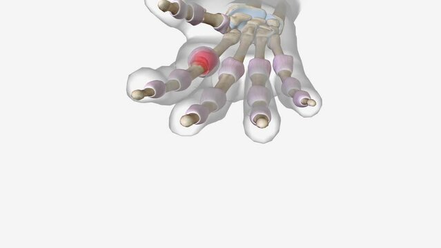 Early Arthritis in Metacarpophalangeal Joint