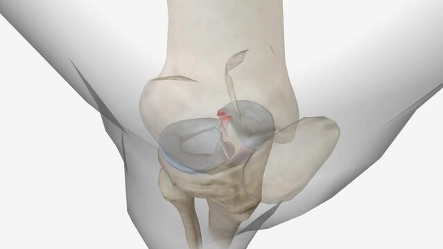 Meniscal root tears are less common than meniscal body tears and frequently go undetected