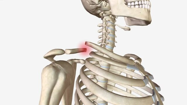 clavicle fracture is a break in the collarbone, one of the main bones in the shoulder