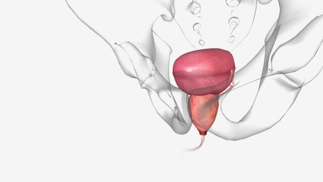 Benign prostatic hyperplasia (BPH) is a non-cancerous condition in which the prostate becomes enlarged with age