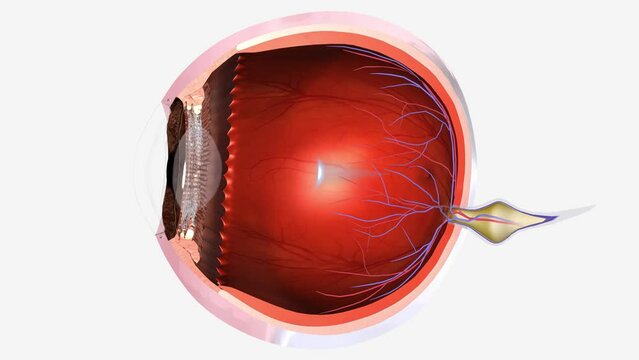 Nearsightedness (myopia) is when close-up objects look clear but distant objects are blurry