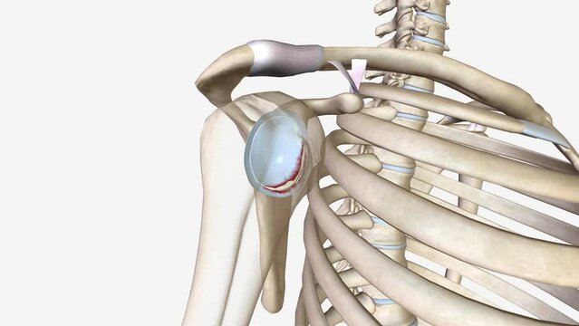 A Bankart lesion occurs as the result of a forward shoulder dislocation