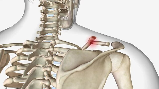 clavicle fracture is a break in the collarbone, one of the main bones in the shoulder